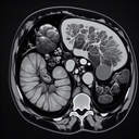 МРТ селезінки